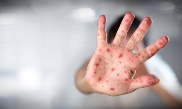 SP contabiliza 4.299 casos de sarampo; há 7 registros em Cajamar