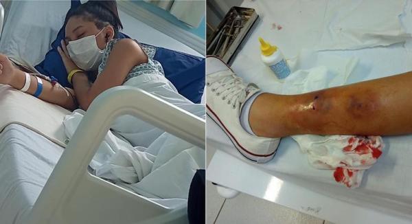 Menina de 14 anos é picada em atividade escolar em Caieiras e corre o risco de perder a perna